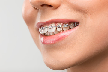 Image showing Beautiful young woman with teeth braces