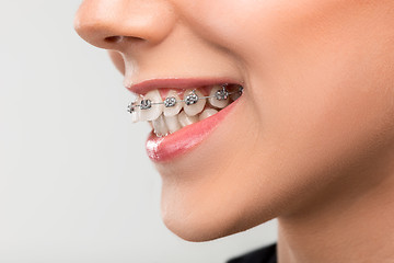 Image showing Beautiful young woman with teeth braces