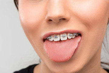 Image showing Beautiful young woman with teeth braces