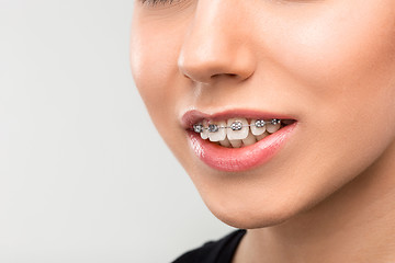 Image showing Beautiful young woman with teeth braces