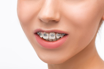 Image showing Beautiful young woman with teeth braces