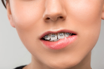 Image showing Beautiful young woman with teeth braces