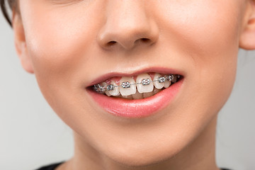 Image showing Beautiful young woman with teeth braces