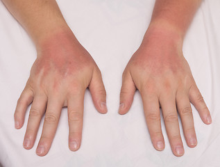 Image showing sunburn