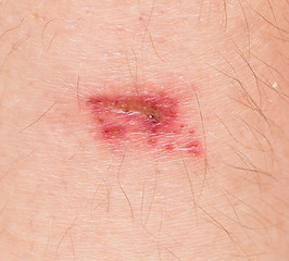 Image showing wound on skin