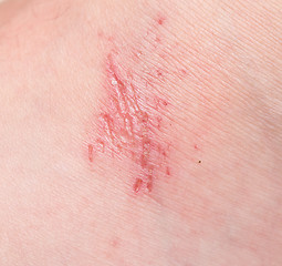 Image showing wound on skin