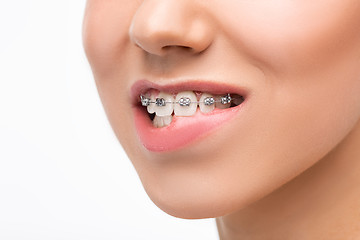 Image showing Beautiful young woman with teeth braces