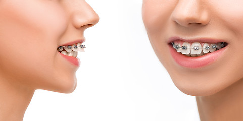 Image showing Beautiful young woman with teeth braces