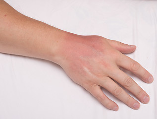 Image showing sunburn