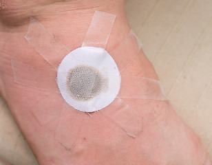 Image showing plaster on foot