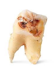 Image showing Closeup single tooth with caries vertically