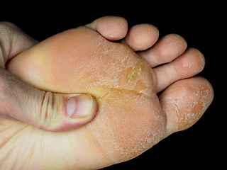 Image showing Skin peeling off from under foot, at closeup towards black