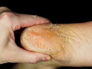 Image showing Skin peeling off from heel of an adult person towards black