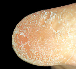 Image showing Closeup of skin peeling off from foot towards black