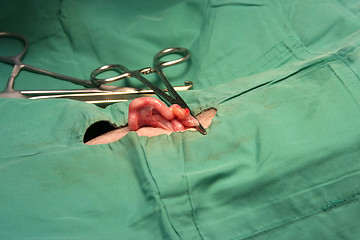 Image showing Clipping off the intestine