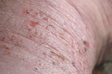 Image showing psoriasis