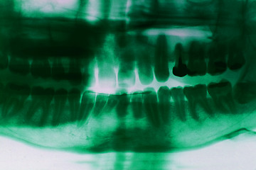 Image showing teeth xray picture