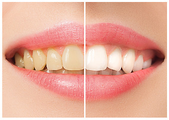 Image showing The female teeth before and after whitening.