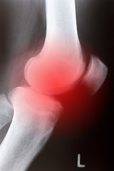 Image showing Human knee sidelong