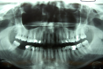 Image showing roentgen – jaw, mandible