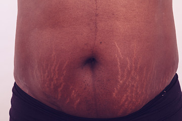 Image showing Stomach with stretch marks