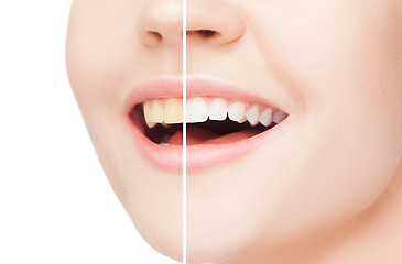 Image showing The female teeth before and after whitening.