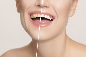 Image showing The female teeth before and after whitening.