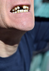 Image showing mouth missing front tooth awaiting implant in senior male citize