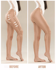 Image showing Woman\'s buttocks before and after plastic surgery