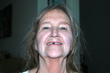 Image showing Female with missing tooth cap.