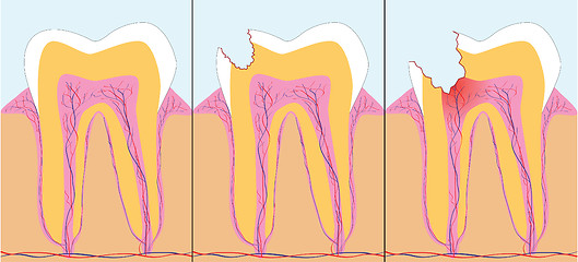 Image showing Three phase of caries