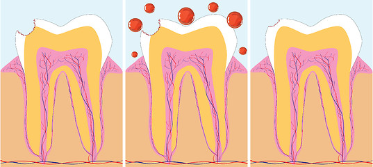 Image showing Three phase of caries treatment