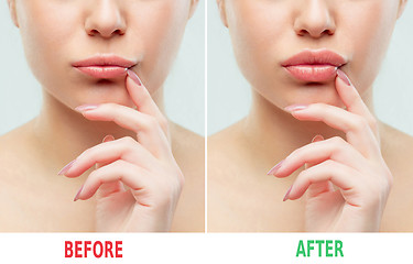 Image showing Before and after lips filler injections. Beauty plastic. Beautiful perfect lips with natural makeup.