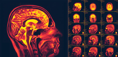 Image showing Magnetic resonance imaging of the brain. MRI scan