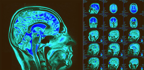 Image showing Magnetic resonance imaging of the brain. MRI scan