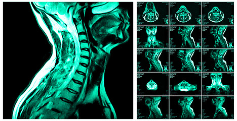 Image showing Magnetic resonance imaging of the cervical spine.