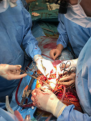 Image showing Surgeons team performing organ transplantation medical surgery.