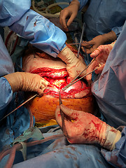 Image showing Surgeons team performing organ transplantation medical surgery.