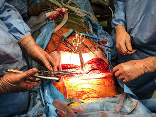 Image showing Surgeons team performing organ transplantation medical surgery.