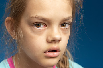 Image showing Conjunctivitis in front of a ten year old girl