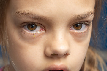 Image showing Irritated eyes of a girl who got sick with conjunctivitis