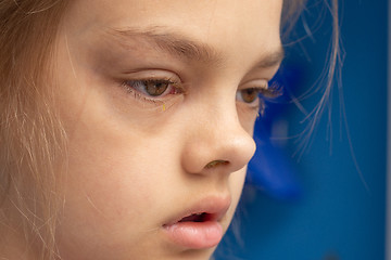 Image showing Ill child, conjunctivitis on the eyes