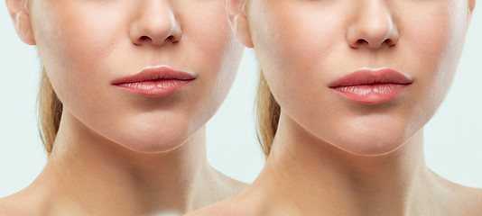 Image showing Before and after lips filler injections. Beauty plastic. Beautif