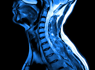 Image showing Magnetic resonance imaging of the cervical spine.