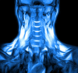Image showing Magnetic resonance imaging of the cervical spine.