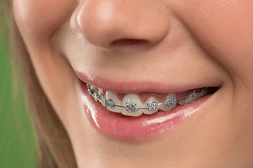 Image showing Beautiful young woman with teeth braces