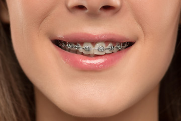 Image showing Beautiful young woman with teeth braces