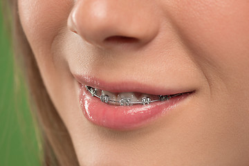 Image showing Beautiful young woman with teeth braces