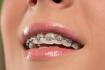 Image showing Beautiful young woman with teeth braces