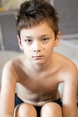 Image showing Boy with chickenpox